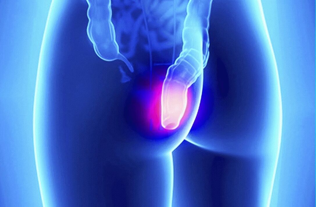 A Gelarex külsőleg és rektálisan is alkalmazható